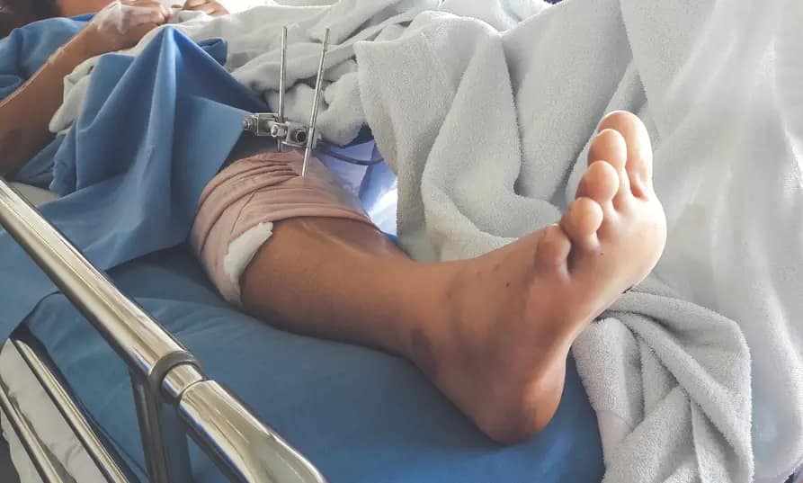 Serious Injuries in a Personal Injury Case