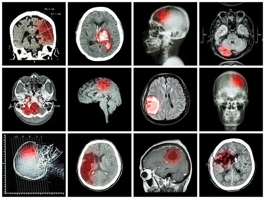 Motorcycle Crash Brain Injury Symptoms
