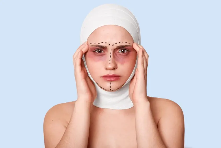 A person wearing a white medical bandage around their head with bruising under the eyes and black surgical marker lines on their face, holding both sides of their head against a light blue background.