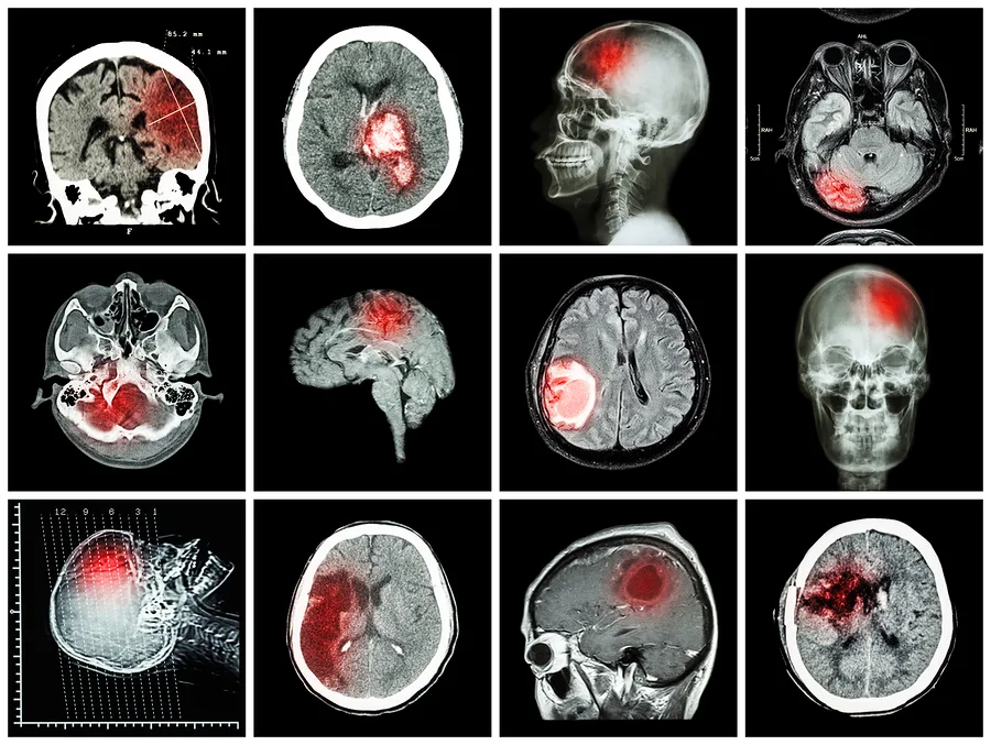 Collection Of Brain Disease