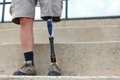 A person wearing khaki shorts and hiking shoes stands on concrete steps. One leg is natural, and the other is a prosthetic limb. A metal fence is visible in the background.