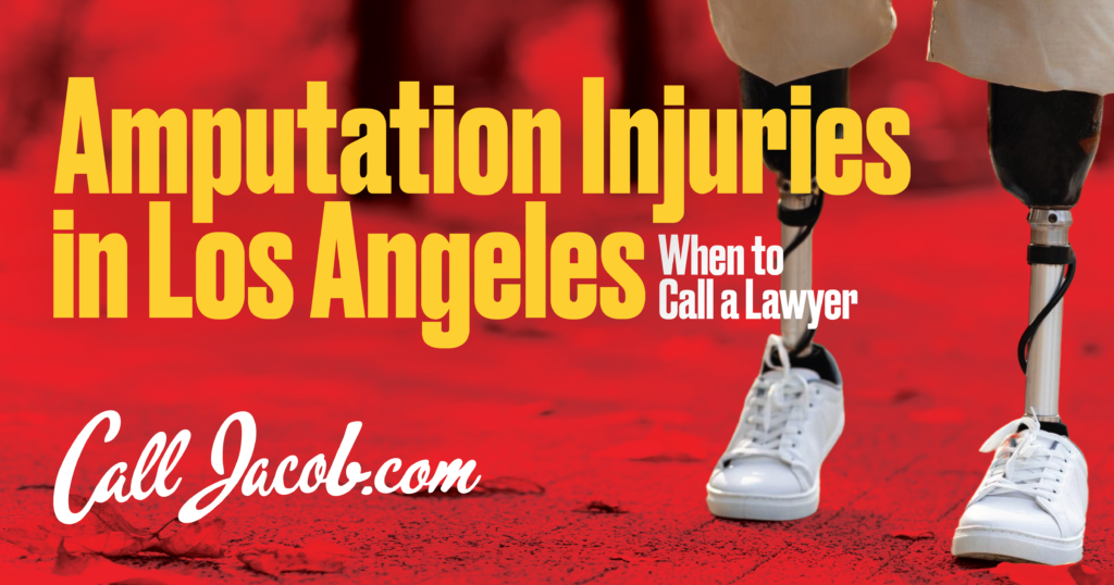 Amputation Injuries in Los Angeles: When to Call a Lawyer
